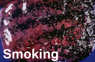 Smoking Damaged Lung